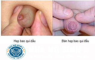 Bán hẹp bao quy đầu là gì và cách chữa trị